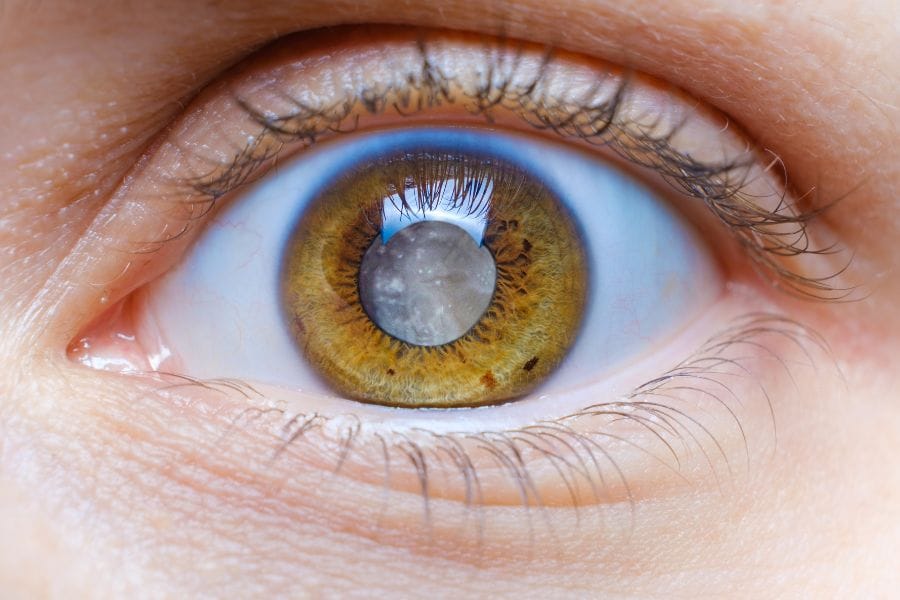 Cirurgia de Catarata: Como ela pode transformar sua visão e qualidade de vida